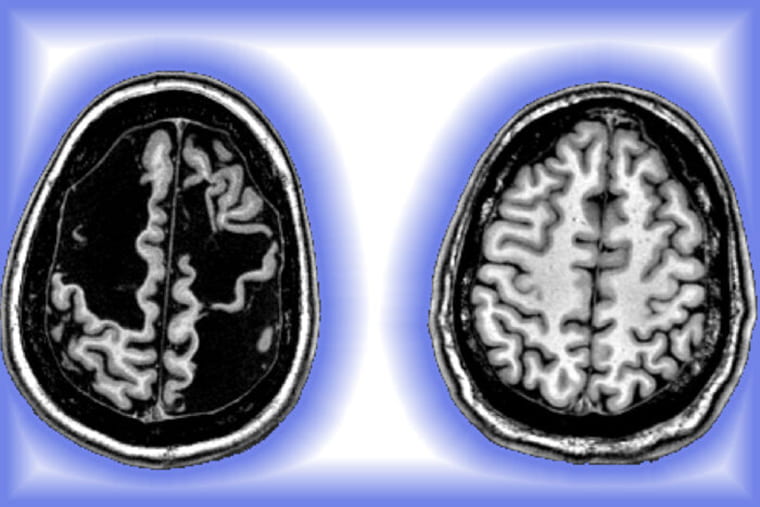 Daniel Carr brain scan